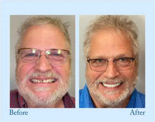 Smileasego™ Premium Dentures