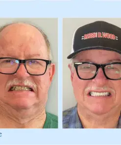 Smileasego™ Premium Dentures