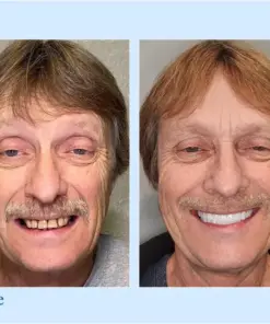 Smileasego™ Premium Dentures