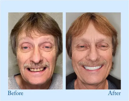 Smileasego™ Premium Dentures