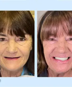 Smileasego™ Premium Dentures