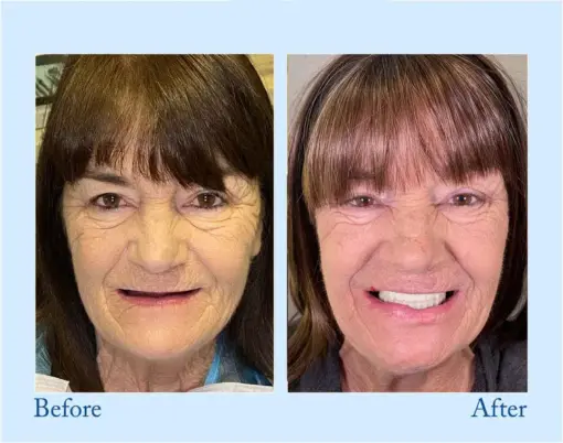 Smileasego™ Premium Dentures