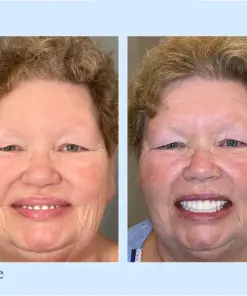 Smileasego™ Premium Dentures