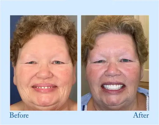 Smileasego™ Premium Dentures