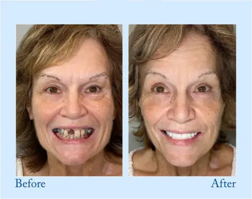 Smileasego™ Premium Dentures